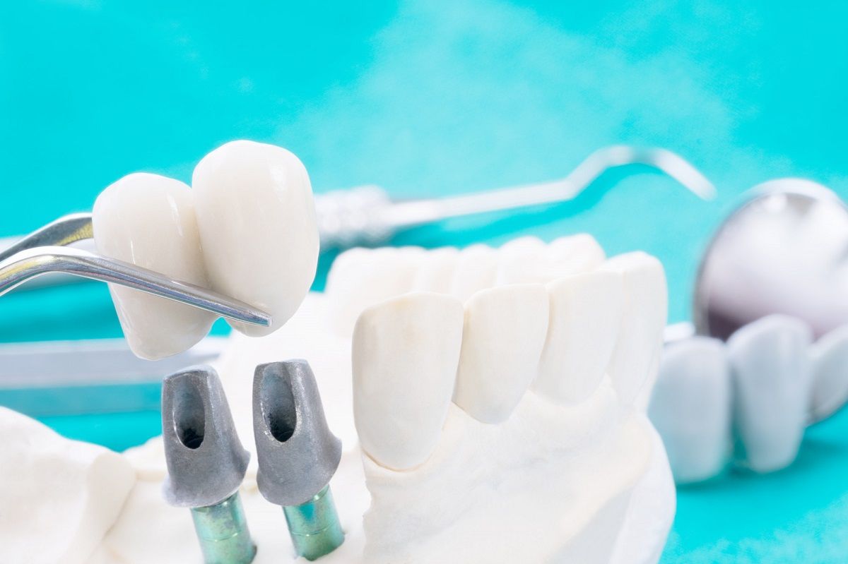 Potential Complications of Dental Bridges: Risks and Limitations