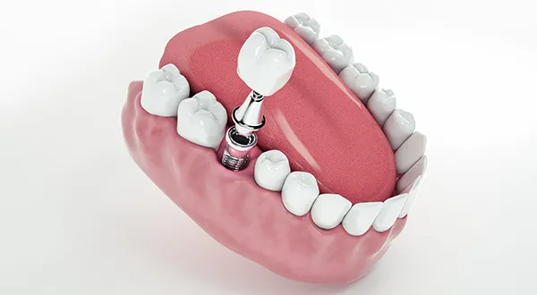 Dental Bridge Alternatives: Other Options for Restoring Your Smile 