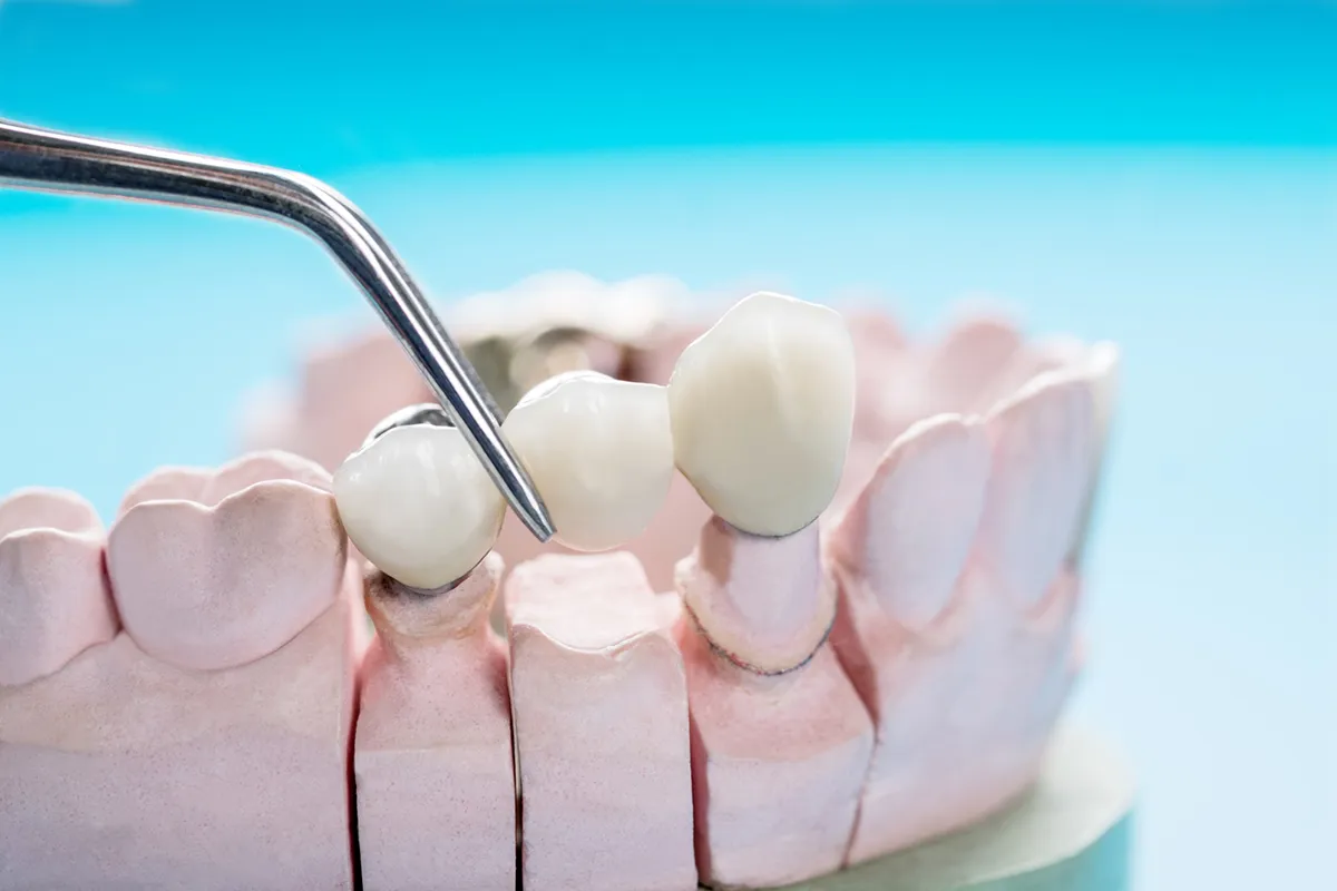 Dental Bridges: In-Depth Exploration and Functionality