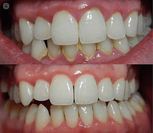 Gingivitis Can Be Treated when it is Detected Early