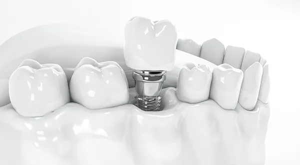 Understanding Dental Implant Types: Exploring Different Types and their Applications