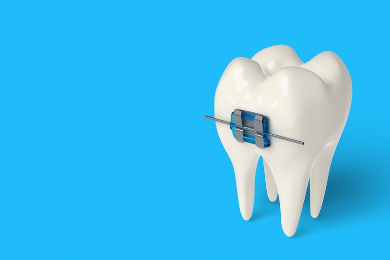 3d-render-tooth-with-ceramic-metal-braces-gums-copy.jpg