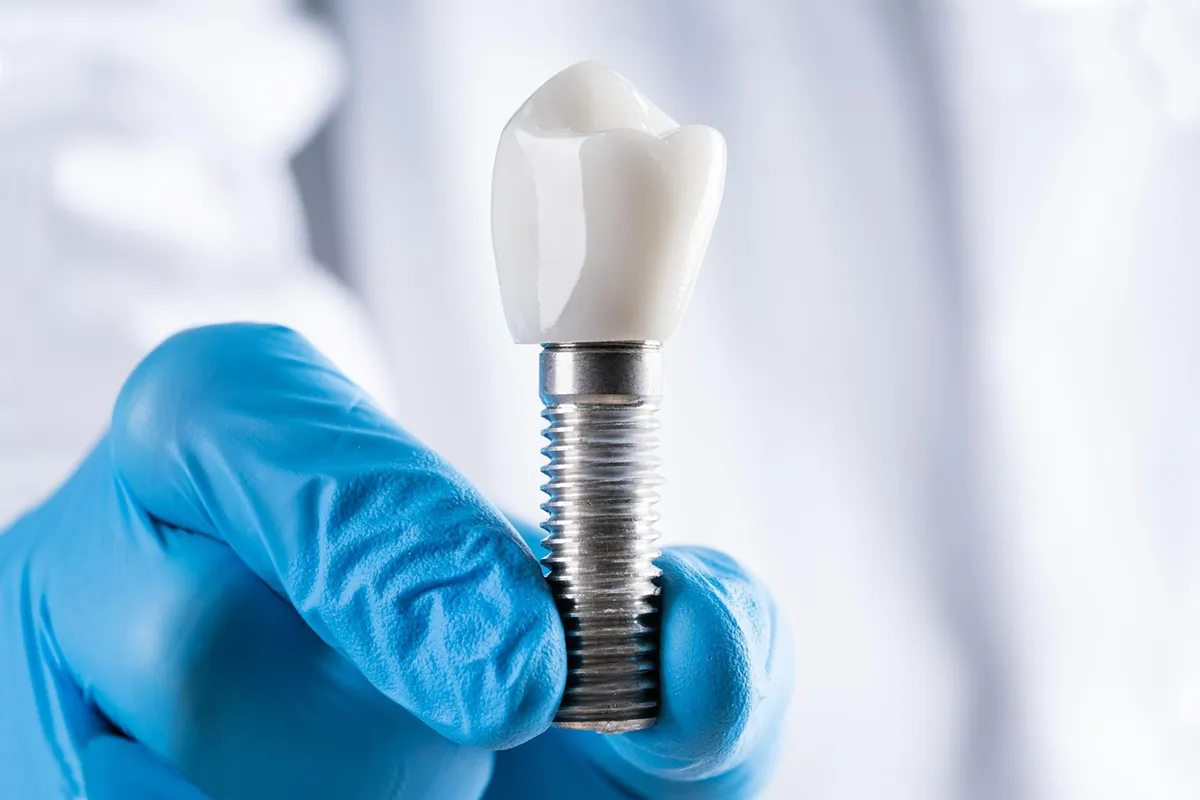 Step-by-Step Dental Implant Placement: A Detailed Look at the Stages of Dental Implant Surgery 