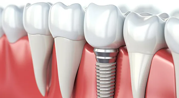 Step-by-Step Dental Implant Placement: A Detailed Look at the Stages of Dental Implant Surgery 