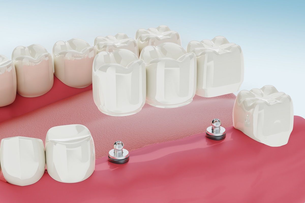 Advantages of Dental Bridges: Restoring Your Smile and Oral Function 