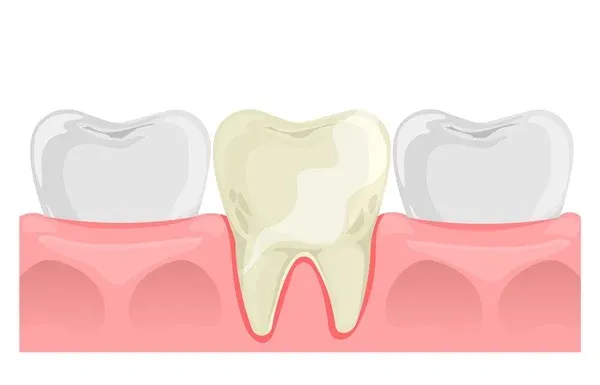 Porcelain Veneers