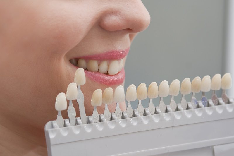 Benefits-of-Dental-Veneers.jpg