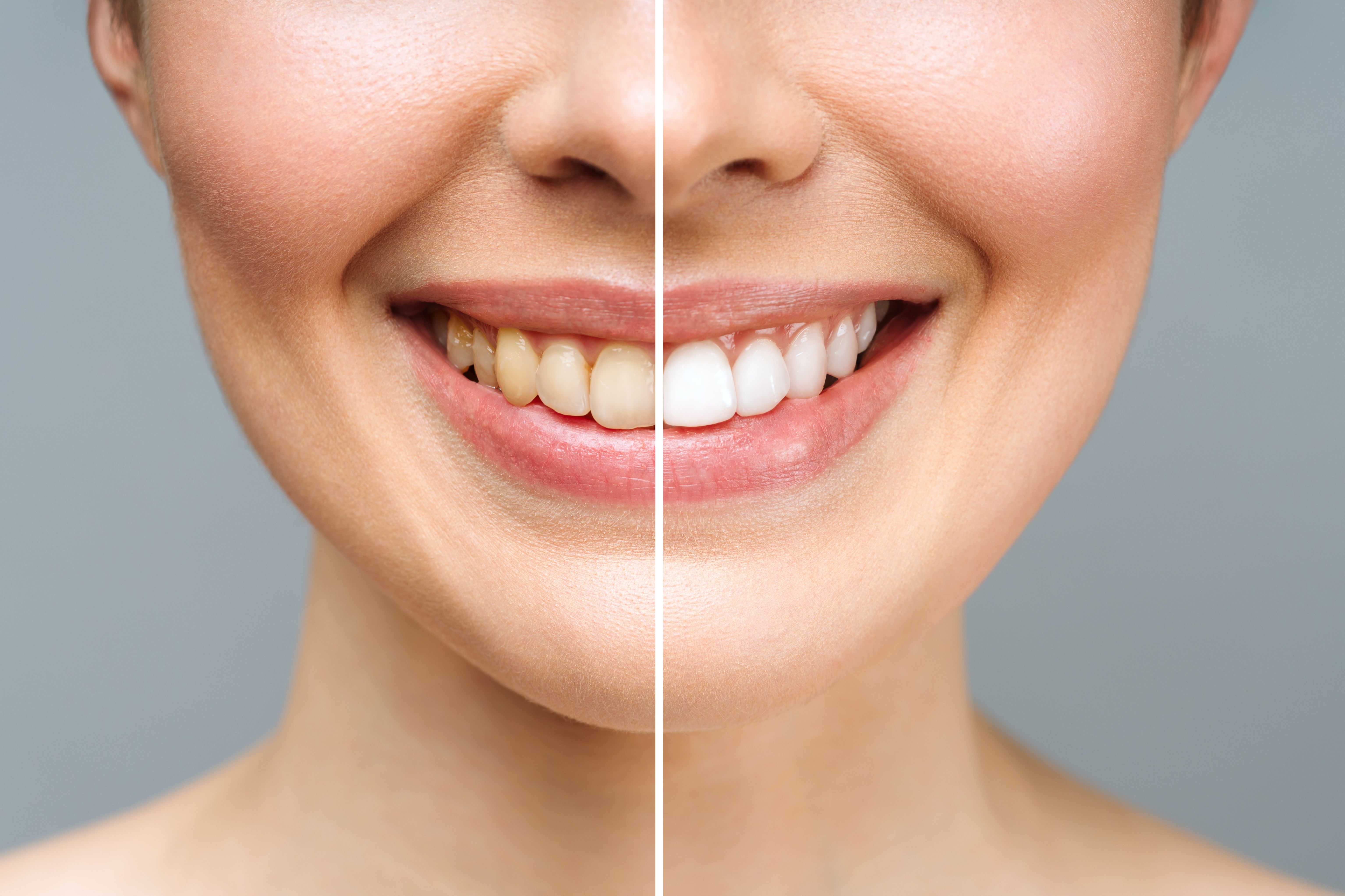 Learn More About Tooth Whitening Technologies