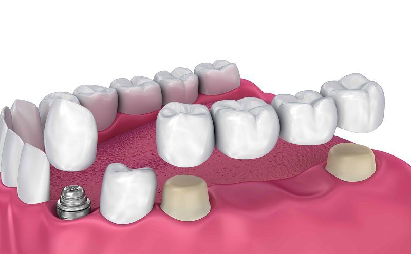 Dental-Bridges-vs-Dental-Implants.jpg