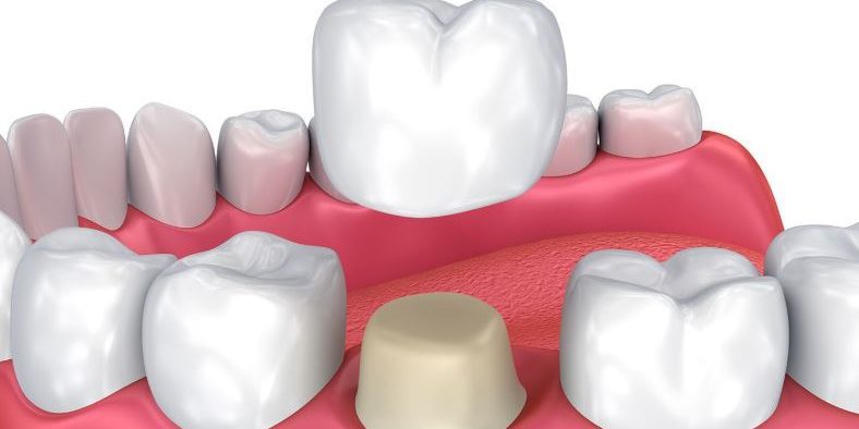Dental-Crown.jpg