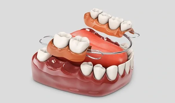 Dental bridges and dental implants