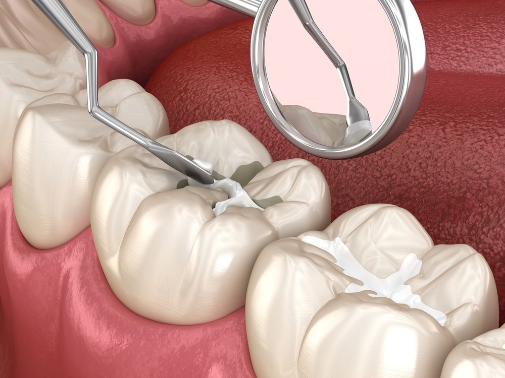 Dental Sealants – A Basic Overview