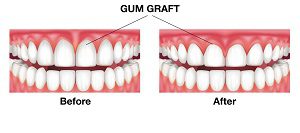 Do I Need Gum Grafting?