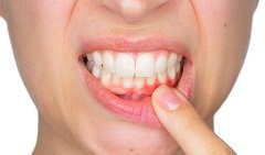 Swollen Gums As Well As Pain While Chewing