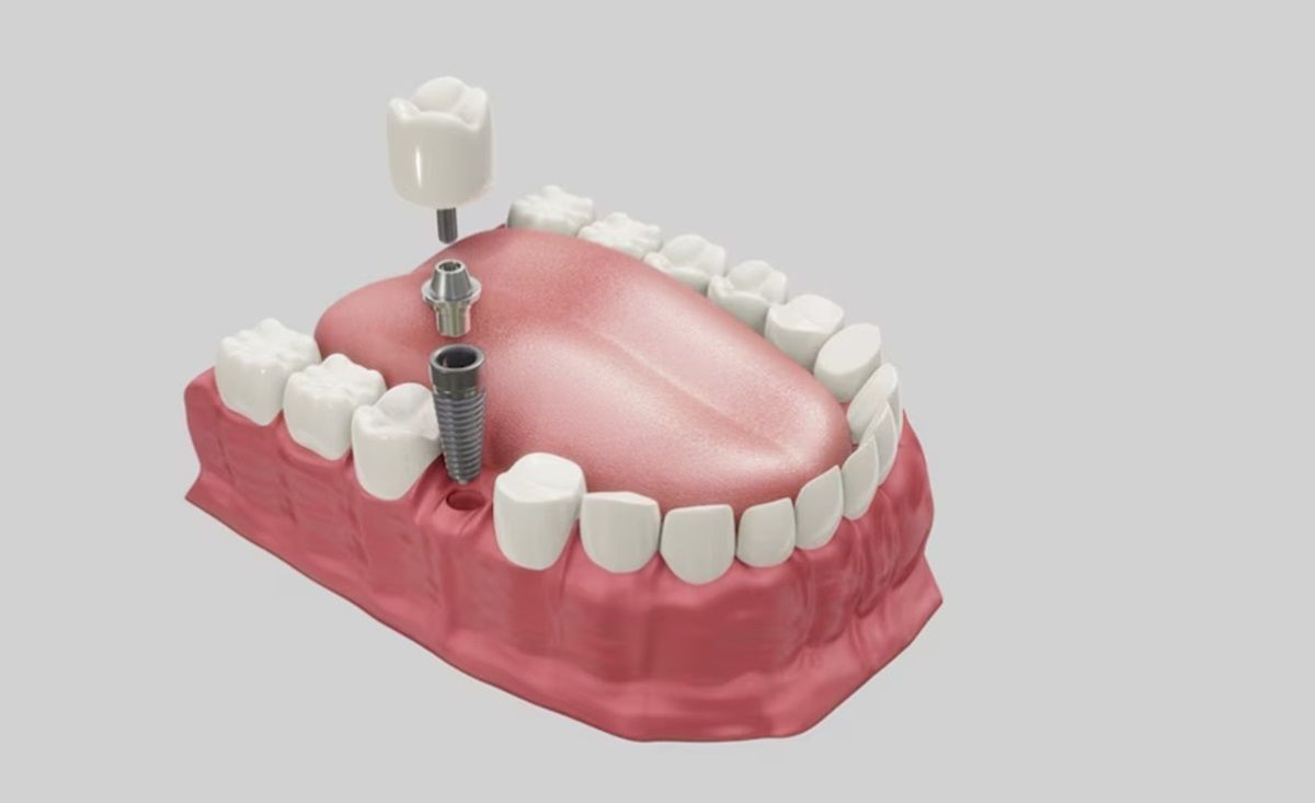 Quality of Life and Dental Implants