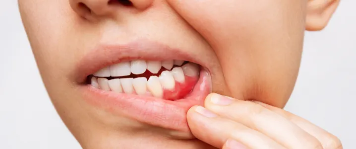 Gum Diseases and Their Side Effects On Overall Health