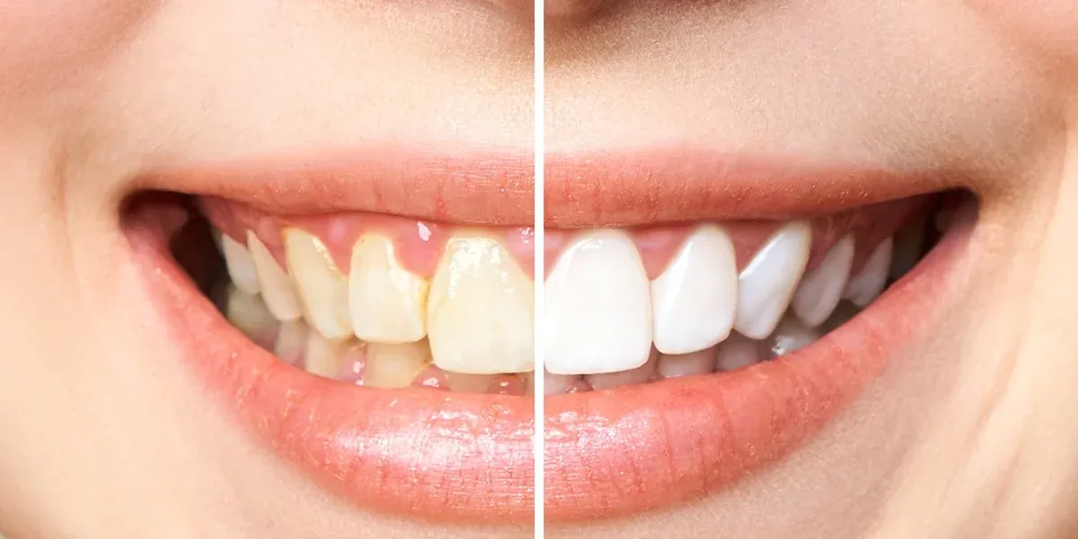 The Role of Diet in Whitening