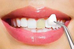 Dental Veneer Benefits for Patients