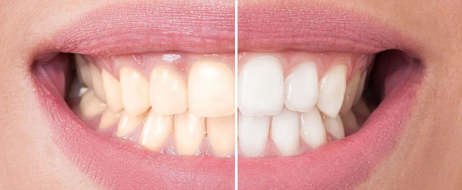 Whitening_54f785d14e.webp