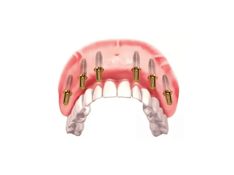 all-on-six-implant.png
