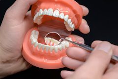 Excellent Solution for Replacing Missing Teeth 