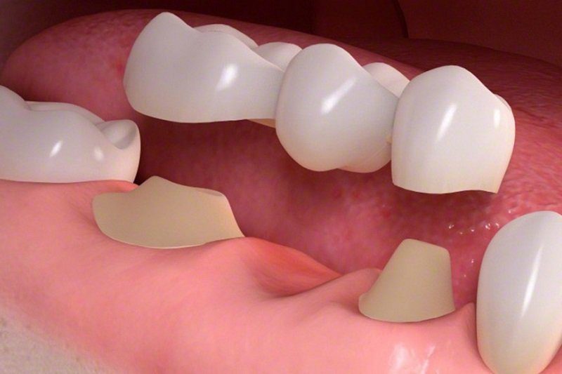 dental-bridges-procedure.jpg