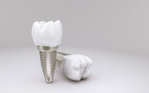 Tooth Implant 