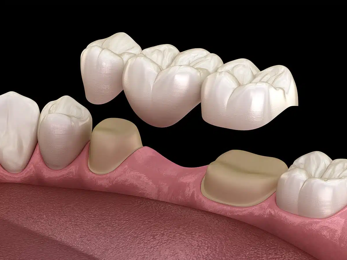 Pros And Cons Of Dental Bridges