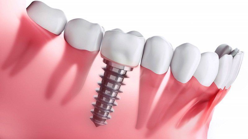 Dental Implant After Care