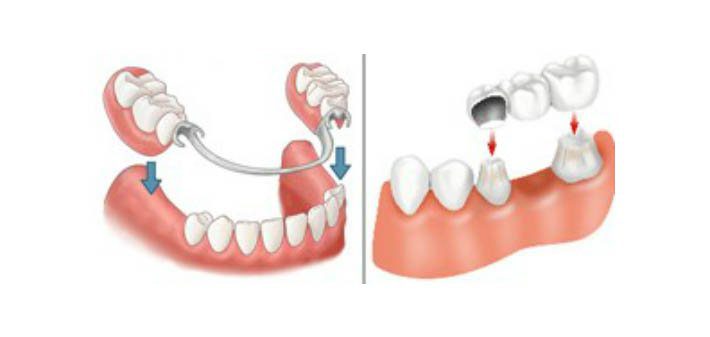 dentures-versus-bridges.jpg