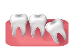 No Pain Associated With Wisdom Teeth Related Problems