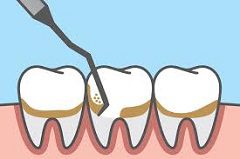Avoiding Periodontitis or Gum Disease is Absolutely Essential