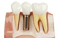 Dental Implants Are Truly a Win-Win For Dental Patients