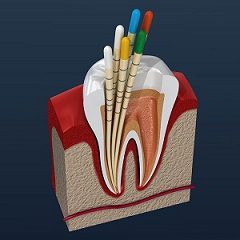 Root Canal Therapy and What It Means To You