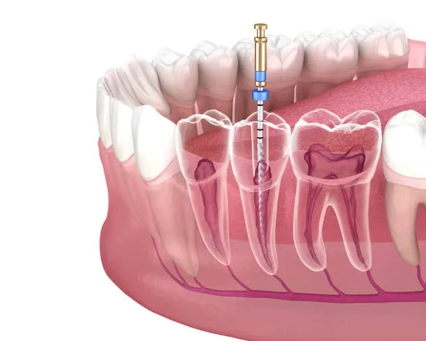 Root Canal is Virtually Painless