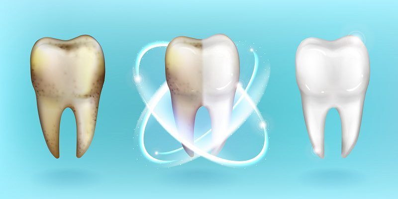 Teeth Whitening Advantages