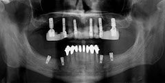 digital dental x rays