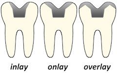 Bonded to The Inner Portion of the Tooth 
