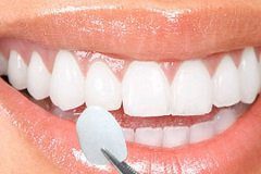 What Is Involved With Getting Dental Veneers?